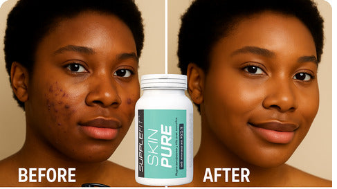 SKIN PURE – Bye Bye l’Acné, Bonjour l’Éclat ! 60 Gelules Made in Italy
